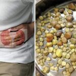 Kidney-Stones-800x468