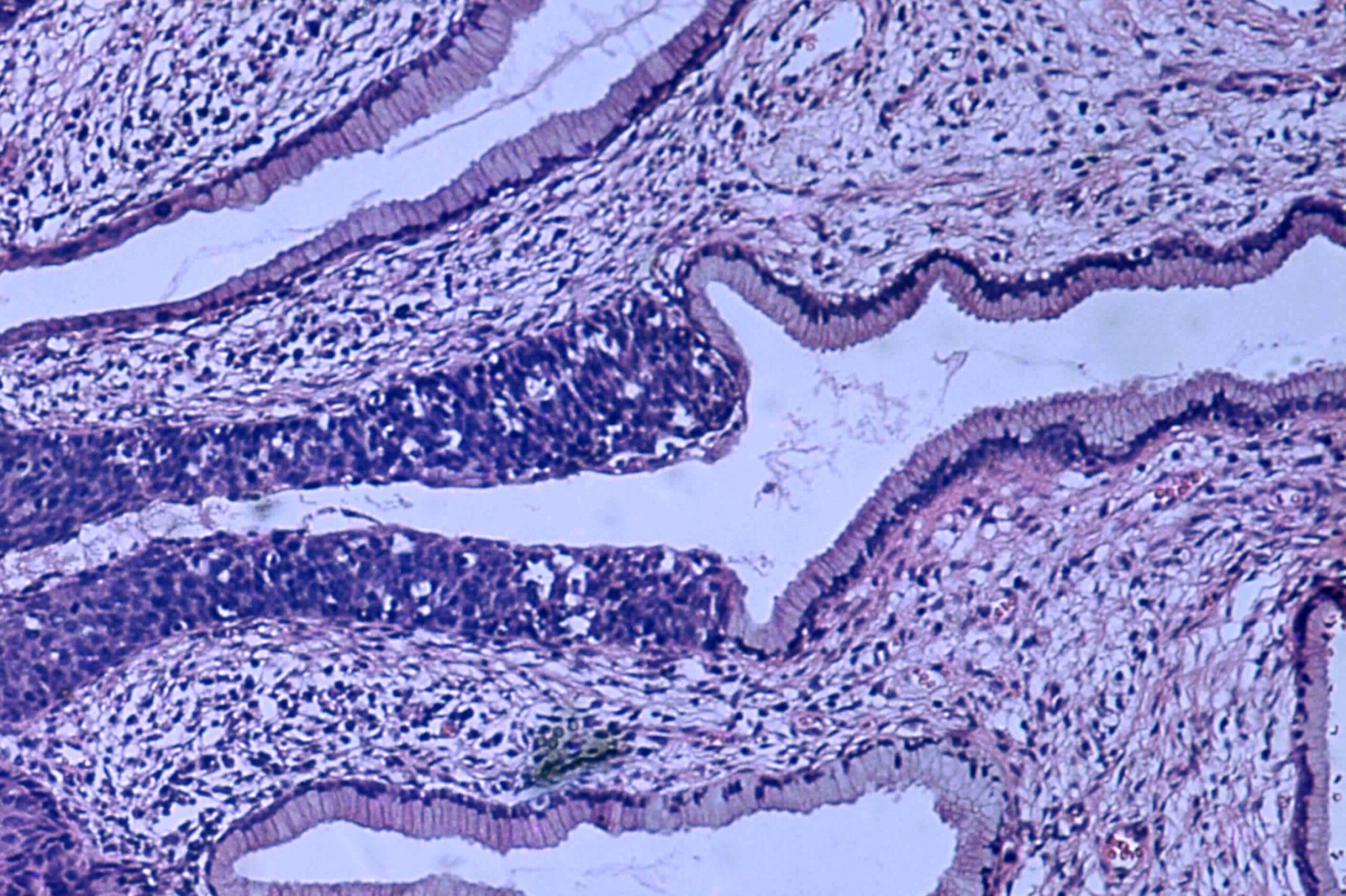 Ca in situ cervix 2 scaled