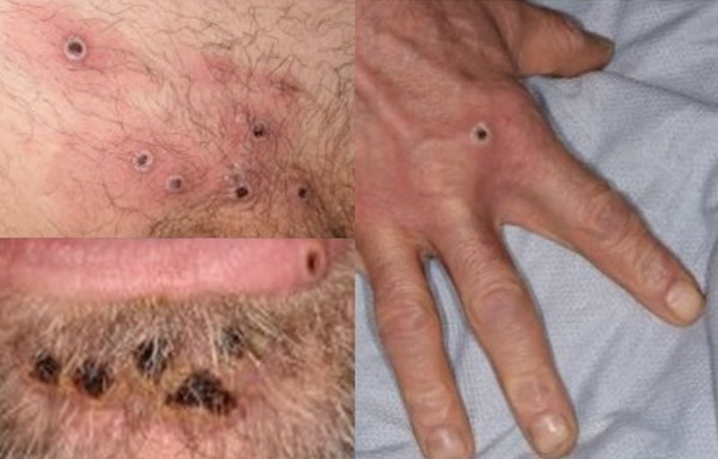 monkeypox rash lesions image 1ed6